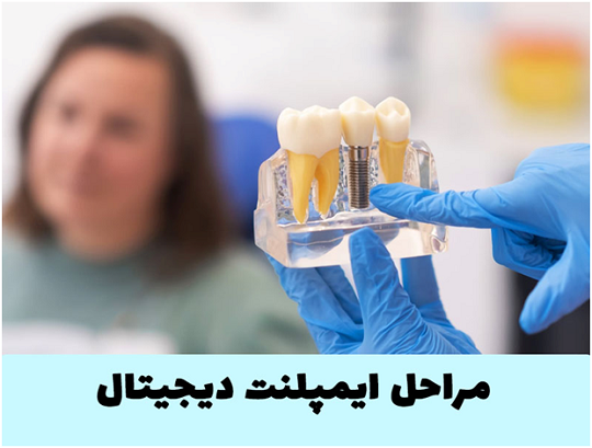 مراحل ایمپلنت دیجیتال